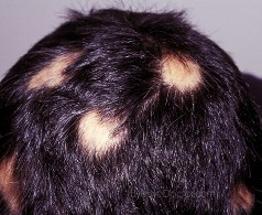 alopecia-areata-3