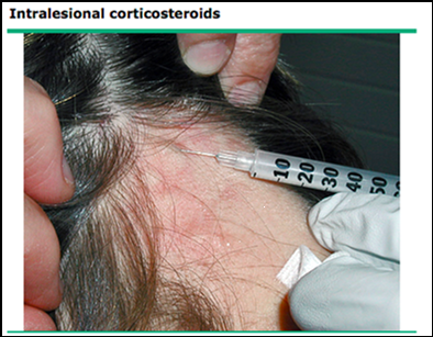 alopecia areata treatment injection